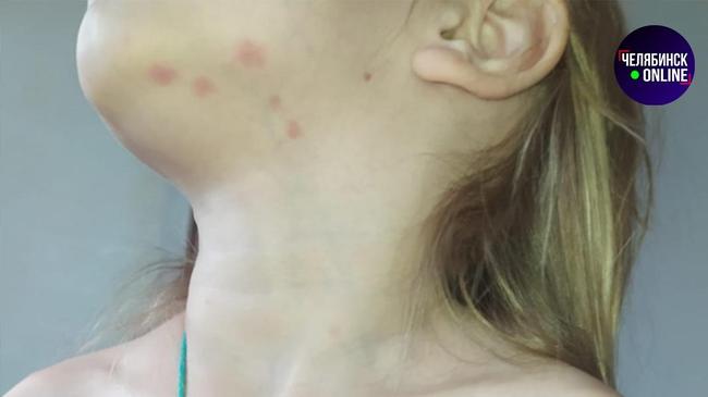 😷 5-летняя челябинка вернулась домой из интерната со странными пятнами на теле