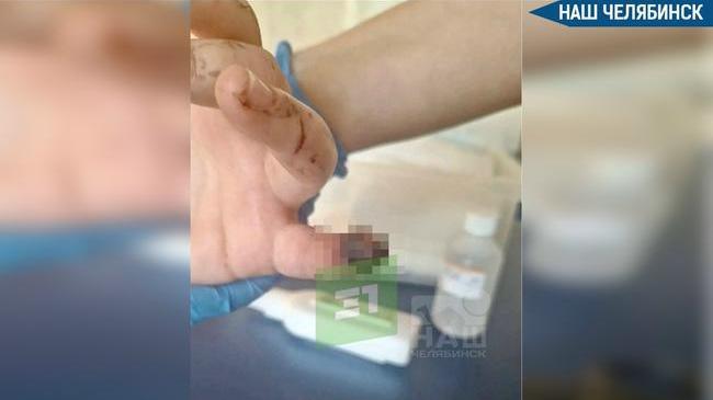 ⚠ В Челябинске девочке пришили палец после травмы на детской площадке