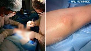 👨‍⚕️ Челябинские онкологи начали удалять опухоли с метастазами в кости