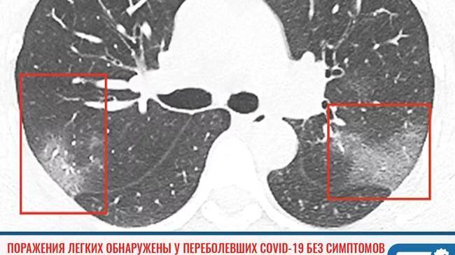 ❗ У бессимптомно переболевших COVID-19 нашли поражения легких 