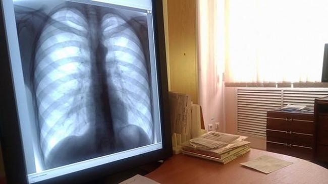 Заболеваемость пневмонией в Челябинской области выросла на 31%