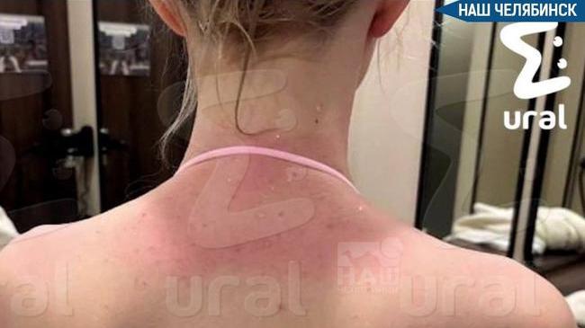 😱 После спа-сеанса у челябинки диагностировали ожог