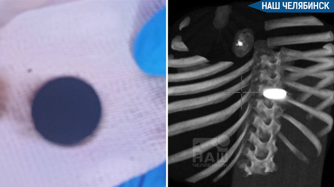 😨 Во время операции у ребёнка нашли монету